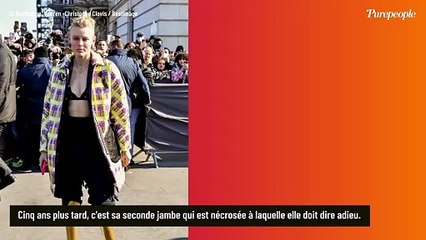 Lauren Wasser, victime du syndrome du choc toxique, se confie sur ses amputations : "Je revis"