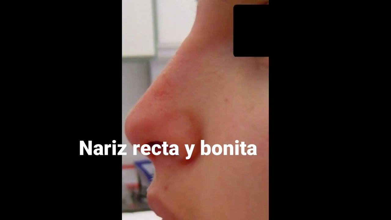 Audio Subliminal Para Tener Nariz Recta Y ""QUITAR JOROBA""