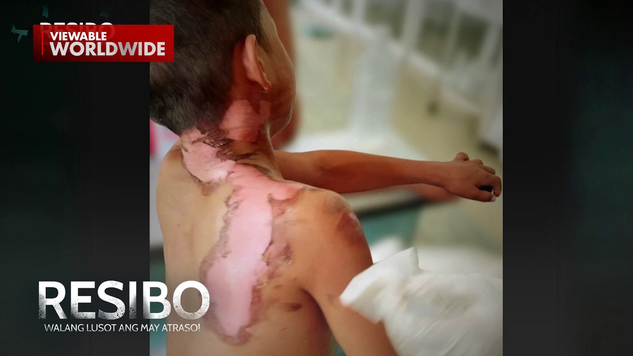 Batang binuhusan ng kumukulong tubig, tinulungan ng #Resibo | Resibo
