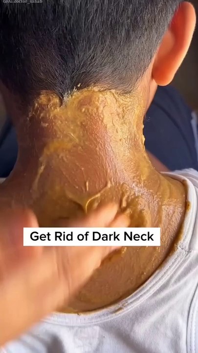 Skin Hyperpigmentation Naturally Removal Tip Fast