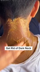 Skin Hyperpigmentation Naturally Removal Tip Fast