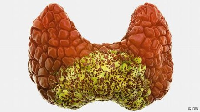 What is an underactive thyroid?