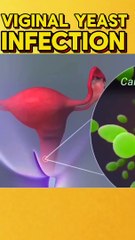 Yeast infection in private part प्राइवेट पार्ट में यीस्ट इन्फेक्शन عدوى الخميرة في الجزء الخاص |#viral #shorts #drsadia1446 #short #yeastinfection #private #3danimation