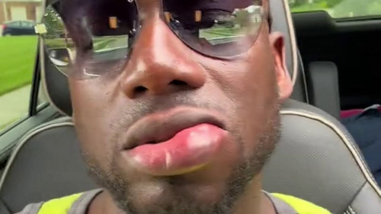 Männliche Lippe schwillt bis zum Dreifachen ihrer Größe durch Bienenstich an