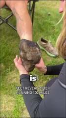 Feet After a 100 Mile Marathon (@BrockCovington)