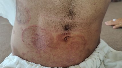 Say Goodbye to Ringworm: Top Tips for Treating Tinea Corporis