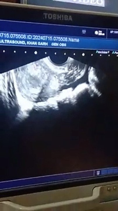 Hemorrhagic ovarian cyst