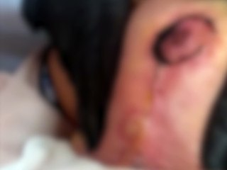 Mulher perde mama após cirurgia com "Cirurgião das Estrelas"