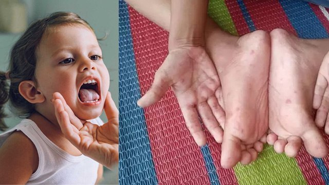 HFMD Disease In Delhi, Causes, Symptoms, Treatment In Hindi|Boldsky