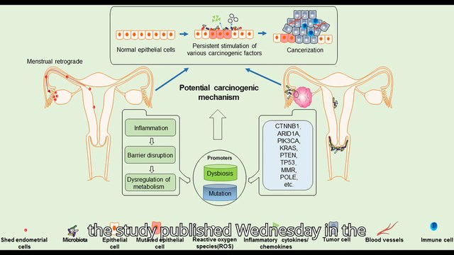 Women with endometriosis face fourfold higher risk of ovarian cancer, study suggests
