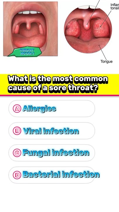Throats infection question answer mcqs  #pharmacologyexam #3dmedico #throat #hospital #disease