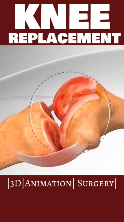 यह रहे हैशटैग और खोजशब्द Knee replacement 3D video Orthopedic surgery animation |#viral  #shorts #3danimationsurgery  #shortsfeeds