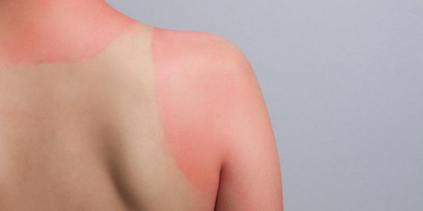 À quel moment doit-on consulter pour des coups de soleil ?