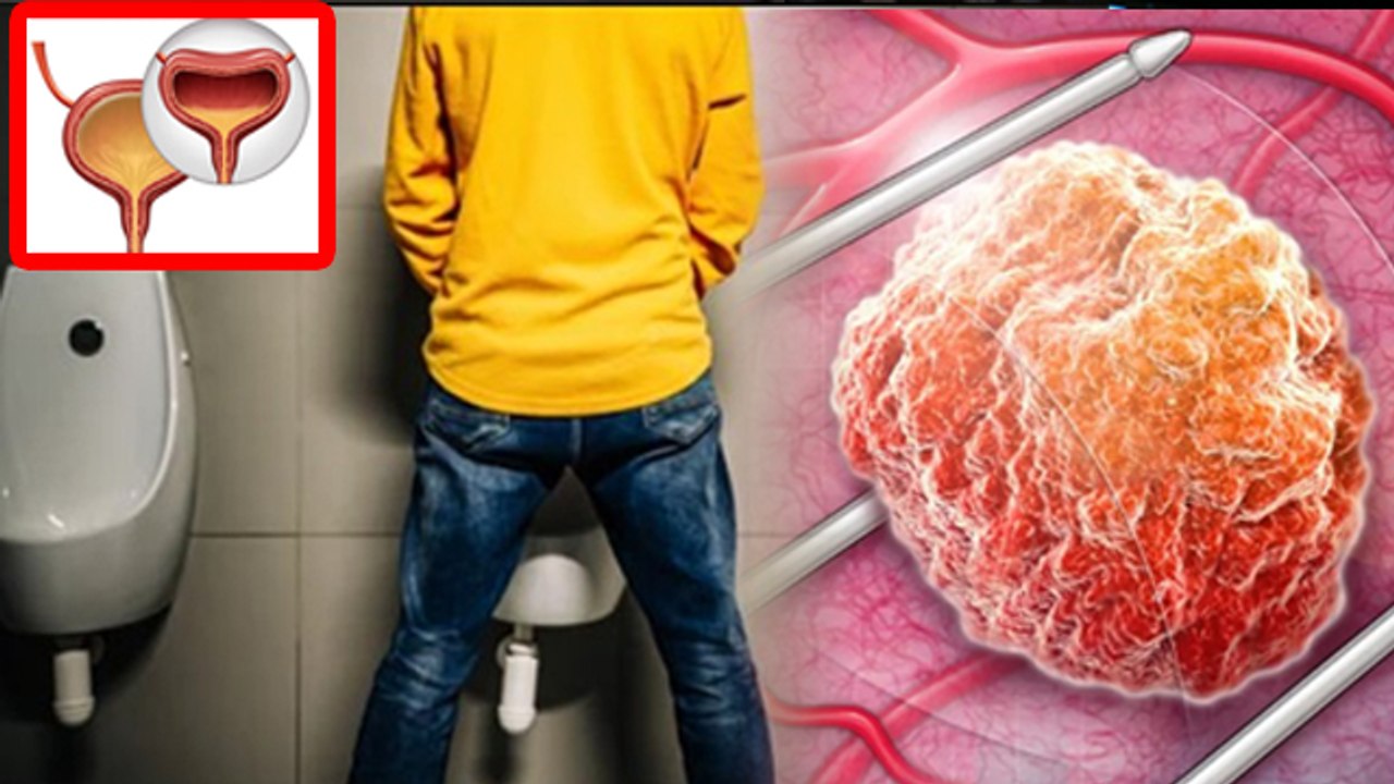 Overactive Bladder In Men: Purush Ko Bar Bar Peshab Kyon Lagta Hai, Causes & Symptoms |Boldsky