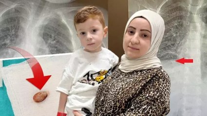 Doktorları bile şaşırtan vaka: Nefes borusundaki çekirdekle 3 yıl yaşadı