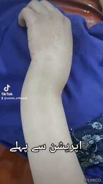 Fracture treatment without stiches