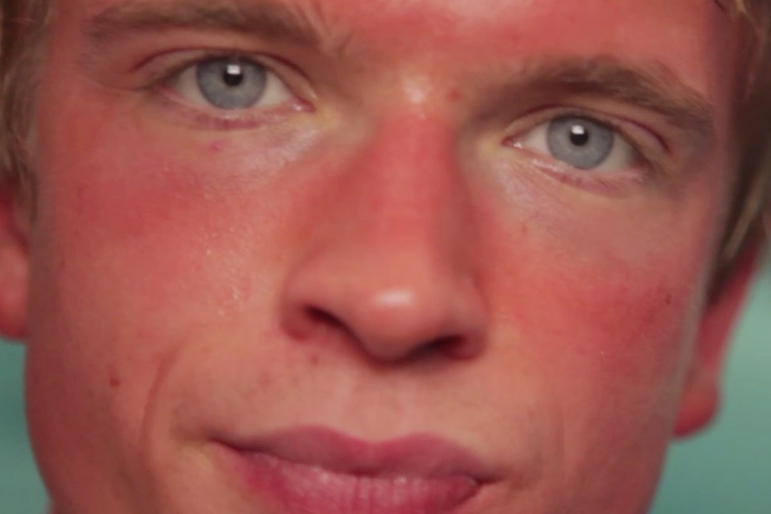 Scottature solari: come curare le ustioni d'estate