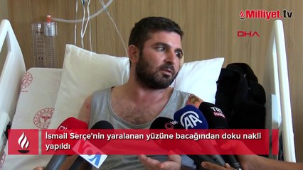 Bacağından alınan doku ile yeni yüzüne kavuştu!