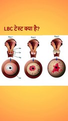 LBC test in hindi | बच्चेदानी के मुंह के कैंसर को पता करने के लिए सबसे अच्छी जांच | Cervical cancer