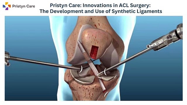 Pristyn Care Innovations in ACL Surgery The Development and Use of Synthetic Ligaments