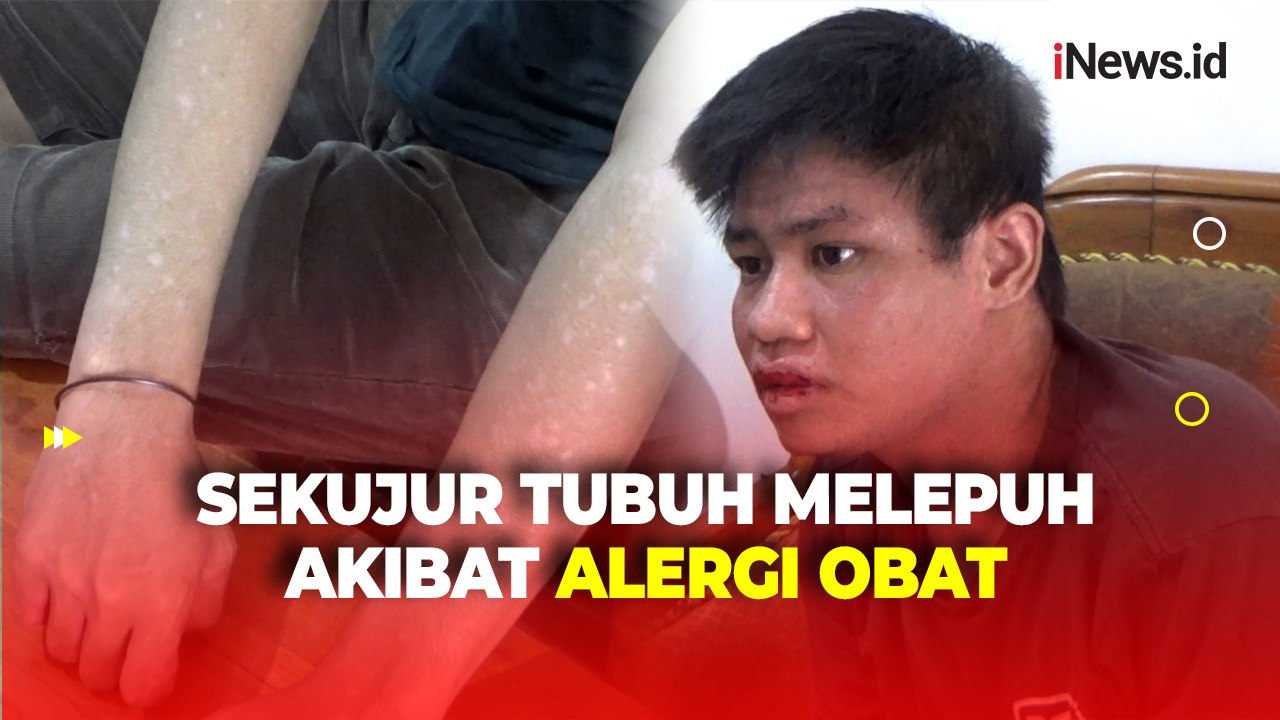 Kulit Sekujur Tubuh Pria di Parepare Ini Melepuh usai Minum Obat dari Puskesmas