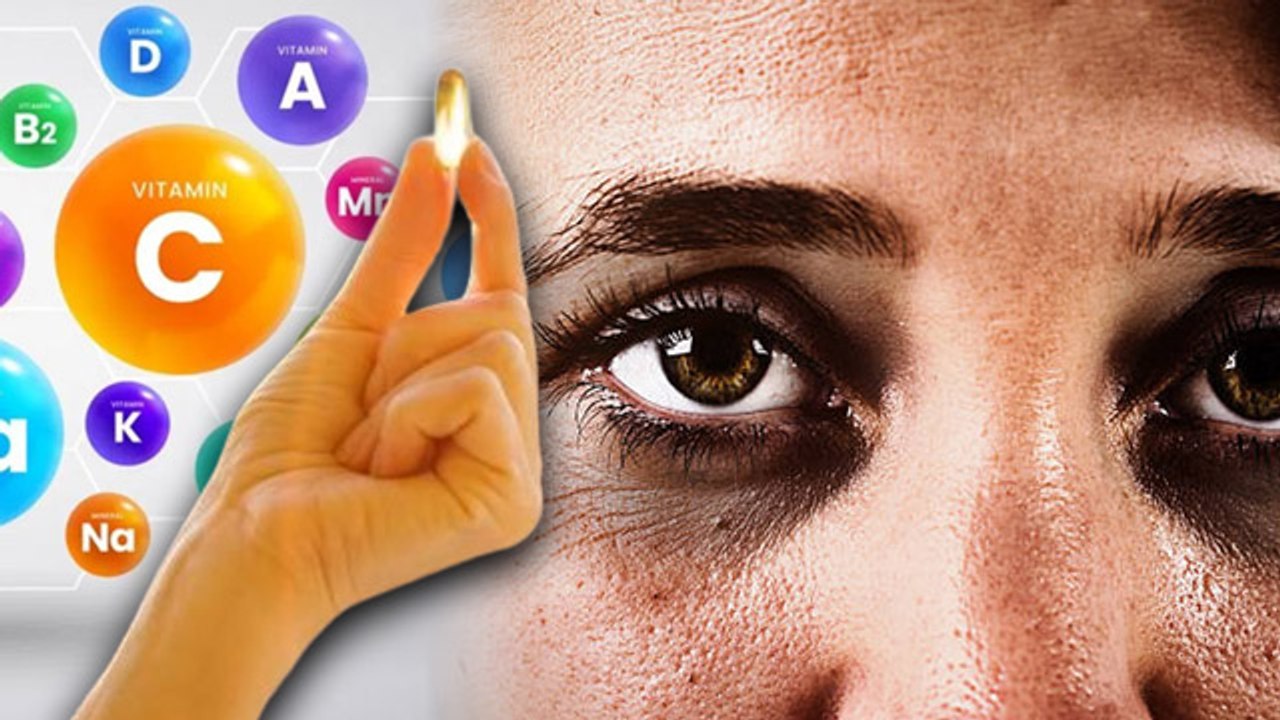 Which Vitamin Deficiency Causes Dark Circles, Kis Vitamin Ki Kami Se Dark Circle Hote Hain | Boldsky