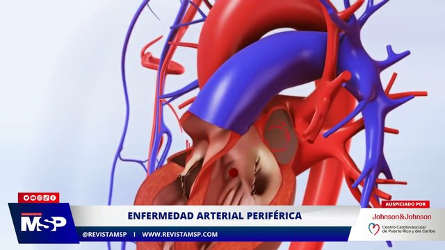Enfermedad arterial periférica - XXXI Congreso Puertorriqueño de Cardiología