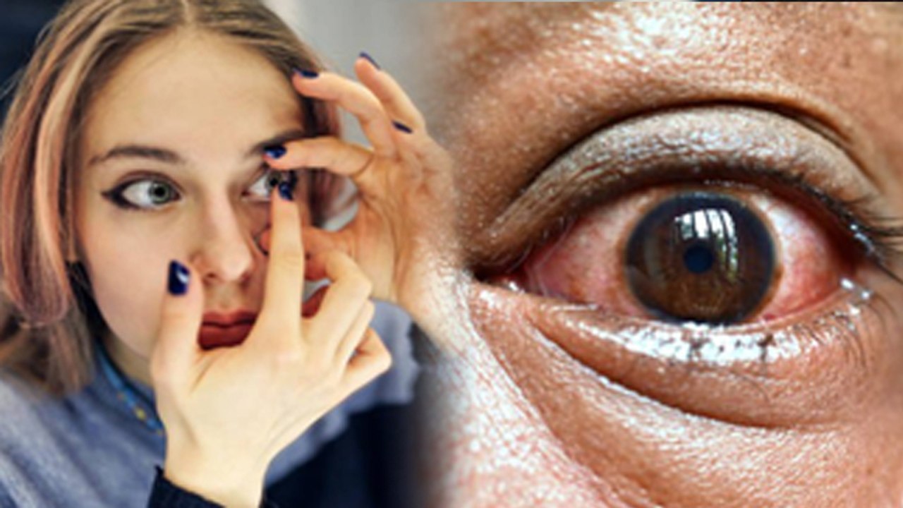 Side Effects of Wearing Colored Contact Lenses | Colored Contact Lenses Pehnne Se Kya Hota Hai |