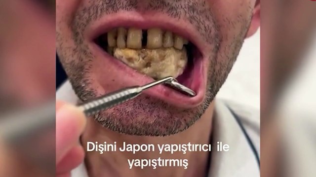 Sallanan dişlerini japon yapıştırıcısıyla yapıştırdı! Diş hekimi gözlerine inanamadı