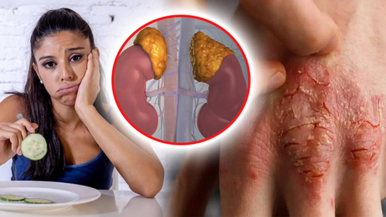 Addison's Disease Explained: Signs & Symptoms,Causes In Hindi| एडिसन रोग क्या है, लक्षण कारण|Boldsky