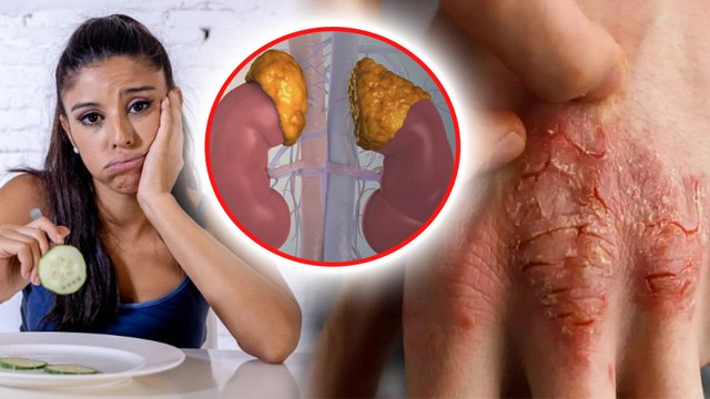 Addison's Disease Explained: Signs & Symptoms,Causes In Hindi| एडिसन रोग क्या है, लक्षण कारण|Boldsky