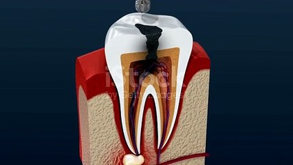 What is root canal treatment?