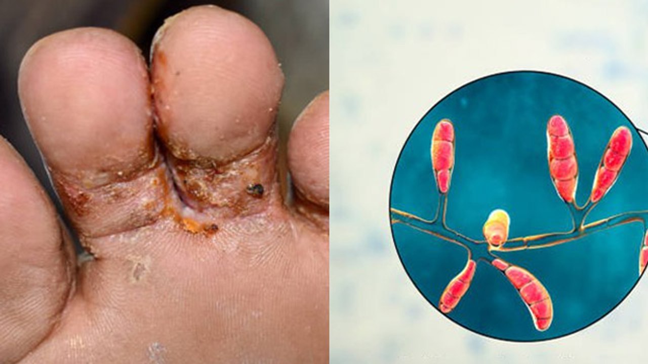 Monsoon Skin Care: Barsat Me Pair Ke Fungal Infection Kaise Thik Kare | Boldsky