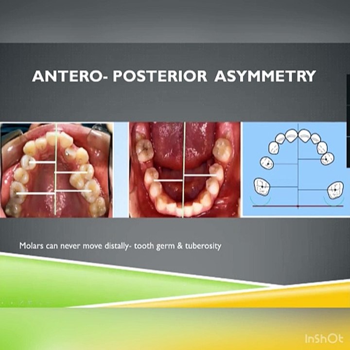 Orthodontic Cast Analysis