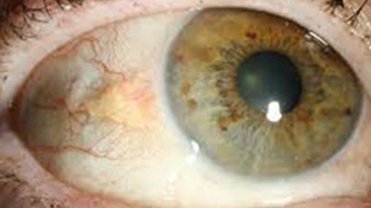 Inside Eyes White Lumps Causes, Symptoms & Treatment: Aankh Ke Andar ...
