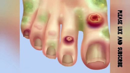 ASMR SATISFYING TOENAIL OF ATHLETE FOOT TREATMENT ANIMATION - Episode 4