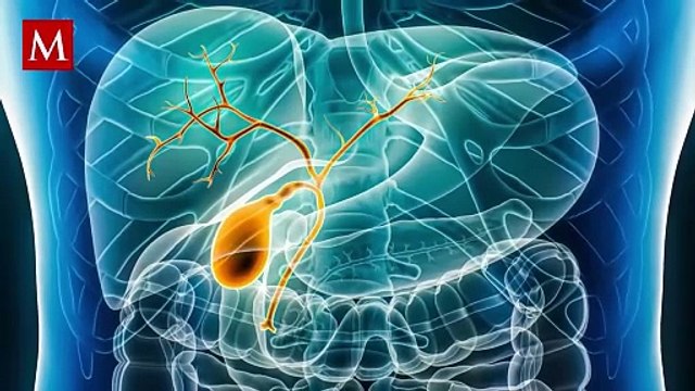 Esta enfermedad silenciosa es difícil de detectar hasta etapas avanzadas; esta es la razón