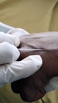 The Essentials of IV Cannulation: Techniques and Tips IV Cannulation: A Comprehensive Guide for Healthcare Professionals Effective IV Cannulation: Skills and Strategies for Success Advanced IV Cannulation: Overcoming Challenges and Improving Outcomes