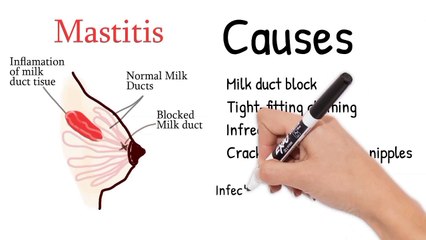Breast pain during lactation or pregnancy.