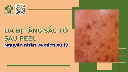 Da bị tăng sắc tố sau peel - Nguyên nhân và cách xử lý
