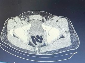 Midesinde taşıdığı 1 kilo uyuşturucuyla yakalandı