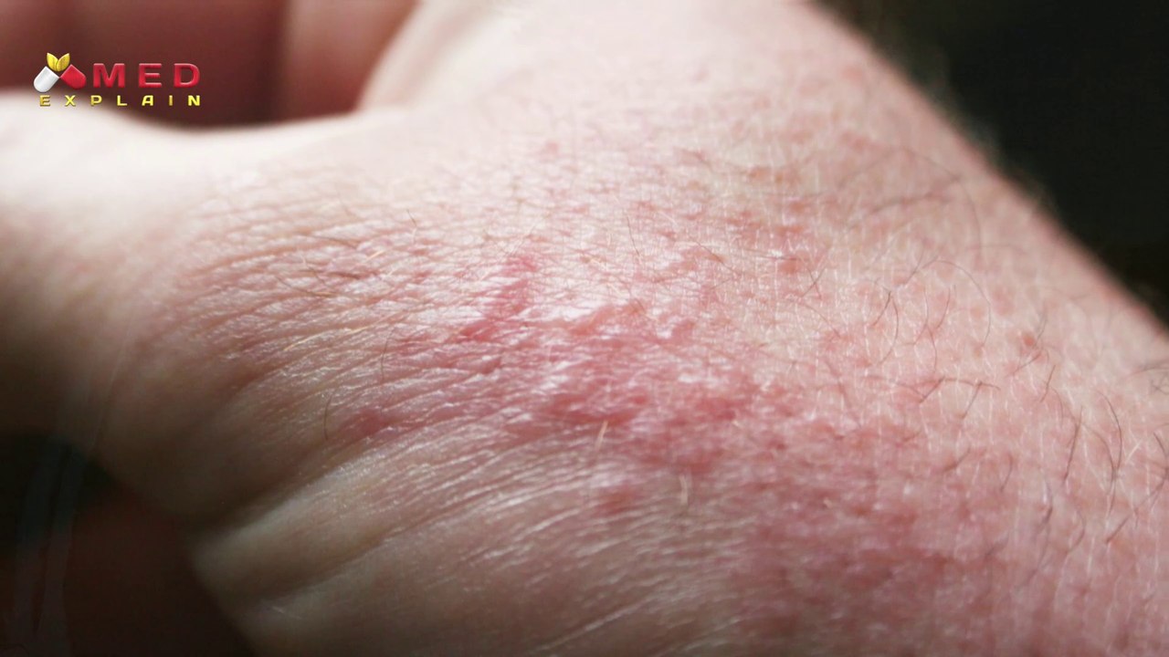 Mediselic ointment | Use of Mediselic | Psoriasis | Eczema | Side effects of Mediselic | Mediselic ointment | खाज खुजली का इलाज | दाद, खाज, खुजली  का इलाज | Psoriasis treatment | Eczema treatment | skin care | Skin infection | Fungal infection |