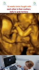 Pregnancy ultrasound #pregnancy