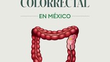 Así es como la Terapia Neoadyuvante Total está demostrando ser un tratamiento exitoso ante el cáncer colorrectal, de acuerdo con