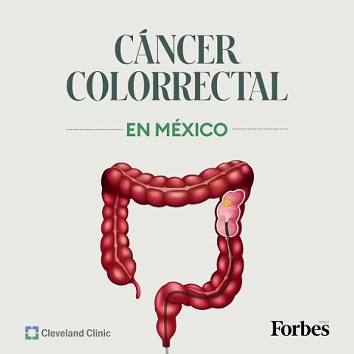 Así es como la Terapia Neoadyuvante Total está demostrando ser un tratamiento exitoso ante el cáncer colorrectal, de acuerdo con