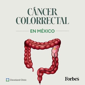 Así es como la Terapia Neoadyuvante Total está demostrando ser un tratamiento exitoso ante el cáncer colorrectal, de acuerdo con