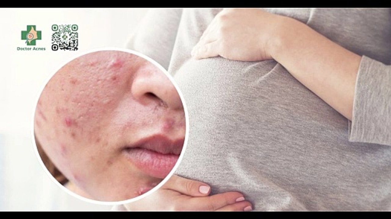 Bà bầu nặn mụn được không? Cách chăm sóc da cho mẹ bầu