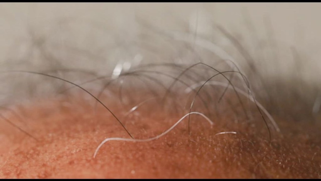 Clinica Tricura: alopecia e calvizie, oggi intervenire si può