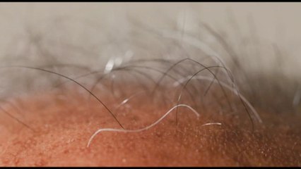Clinica Tricura: alopecia e calvizie, oggi intervenire si può