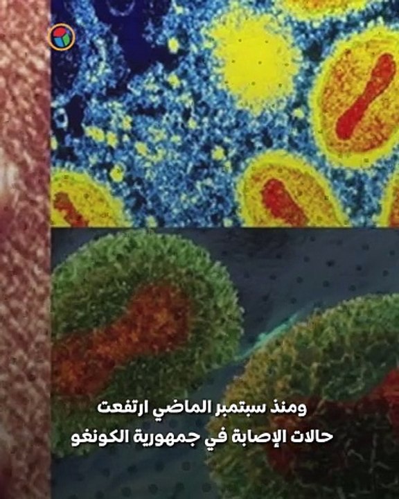 فيروس جدري القردة انتشار متزايد يثير قلق الصحة العالمية